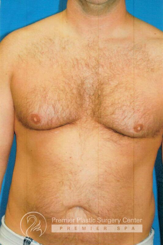 Gynecomastia Before & After Image