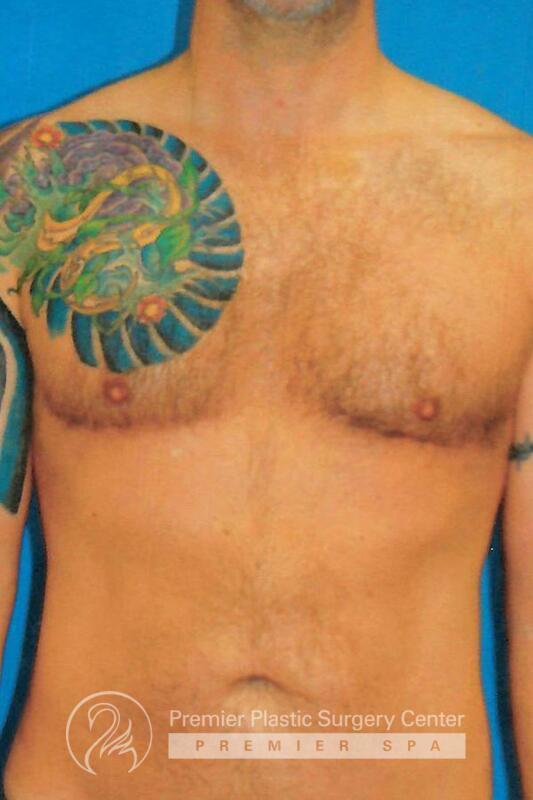 Gynecomastia Before & After Image