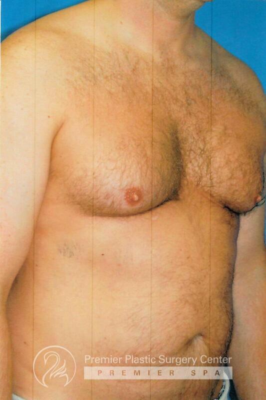Gynecomastia Before & After Image