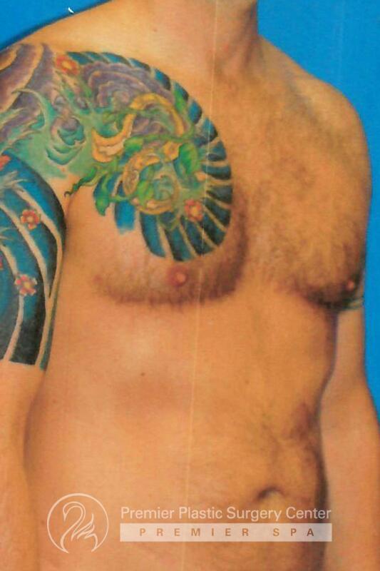 Gynecomastia Before & After Image