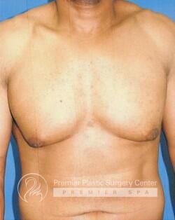 Gynecomastia Before & After Image