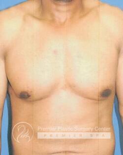 Gynecomastia Before & After Image