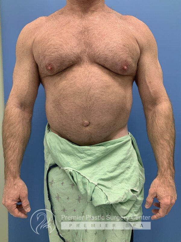 Gynecomastia Before & After Image