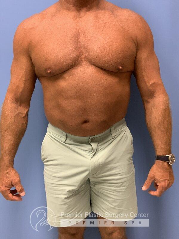Gynecomastia Before & After Image