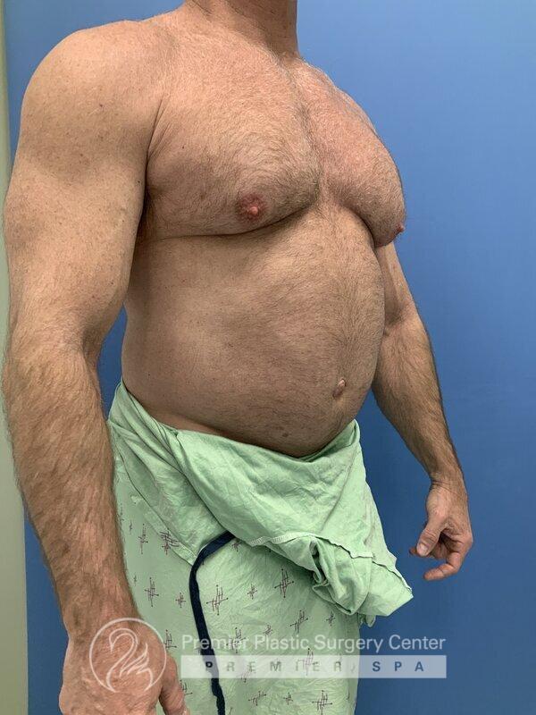 Gynecomastia Before & After Image