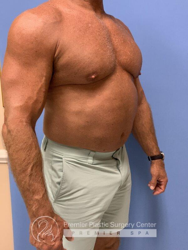 Gynecomastia Before & After Image