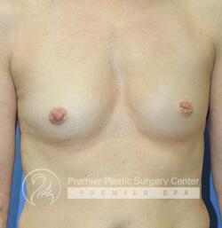 Inverted Nipples Before & After Image