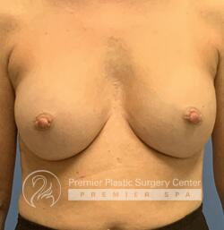 Inverted Nipples Before & After Image