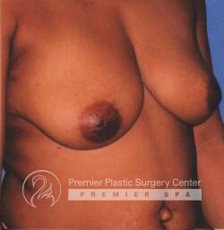 Inverted Nipples Before & After Image