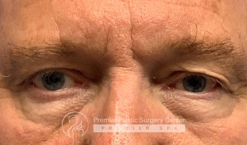 Blepharoplasty Before & After Image