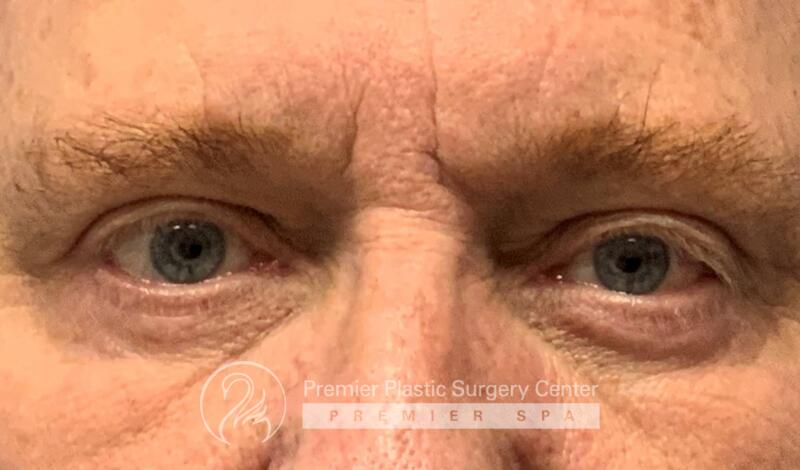Blepharoplasty Before & After Image