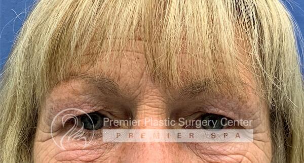 Blepharoplasty Before & After Image