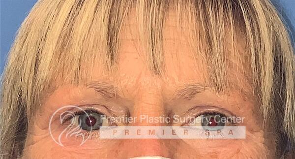 Blepharoplasty Before & After Image