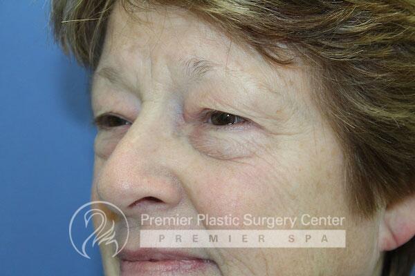Blepharoplasty Before & After Image