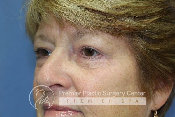 Blepharoplasty Before & After Image