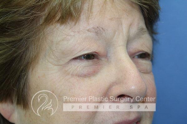 Blepharoplasty Before & After Image