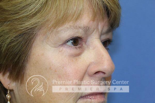 Blepharoplasty Before & After Image