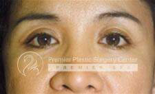 Blepharoplasty Before & After Image