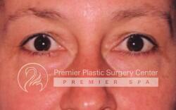 Blepharoplasty Before & After Image