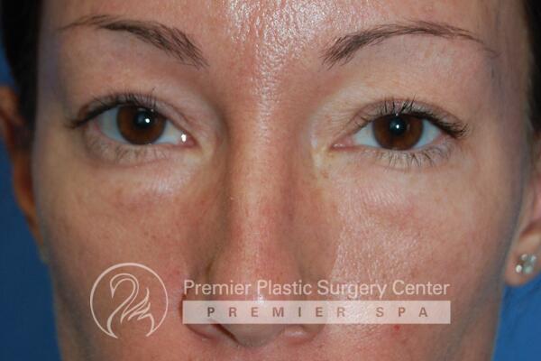 Blepharoplasty Before & After Image