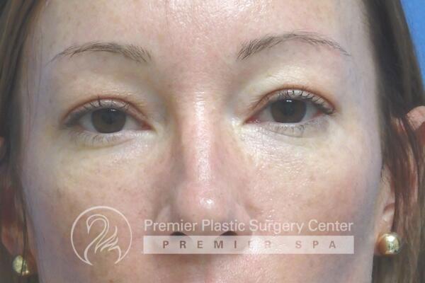 Blepharoplasty Before & After Image