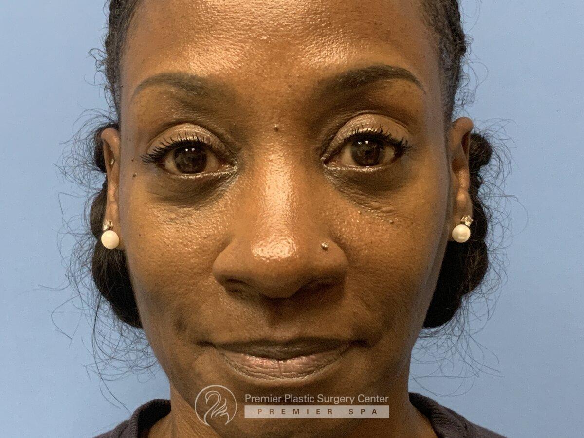 Blepharoplasty Before & After Image