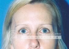 Brow Lifts Before & After Image
