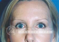 Brow Lifts Before & After Image