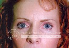 Brow Lifts Before & After Image