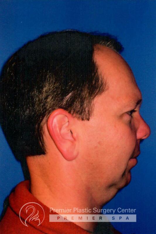 Chin Implants Before & After Image