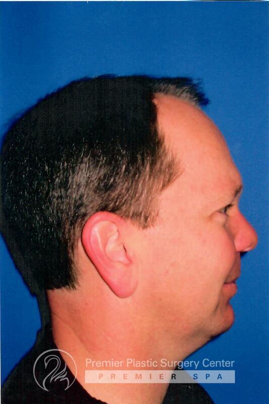 Chin Implants Before & After Image