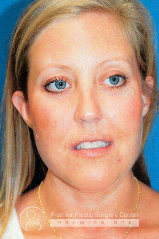 Facelift Before & After Image