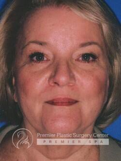 Facelift Before & After Image