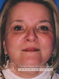 Facelift Before & After Image
