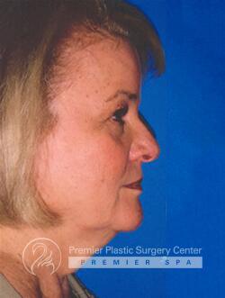 Facelift Before & After Image