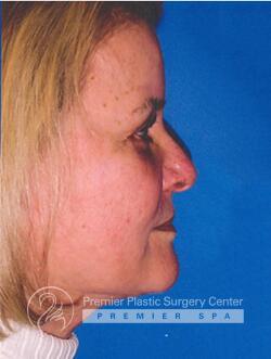 Facelift Before & After Image