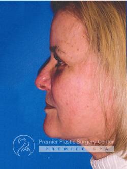 Facelift Before & After Image