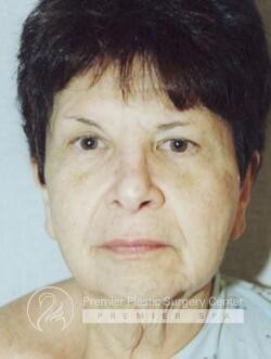 Facelift Before & After Image