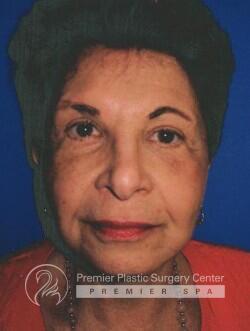 Facelift Before & After Image