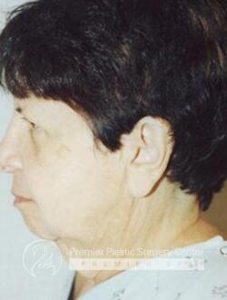 Facelift Before & After Image