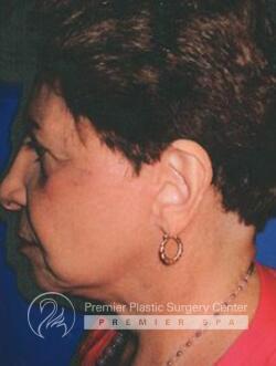 Facelift Before & After Image