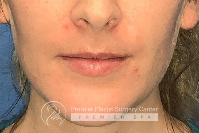 Lip Augmentation Before & After Image