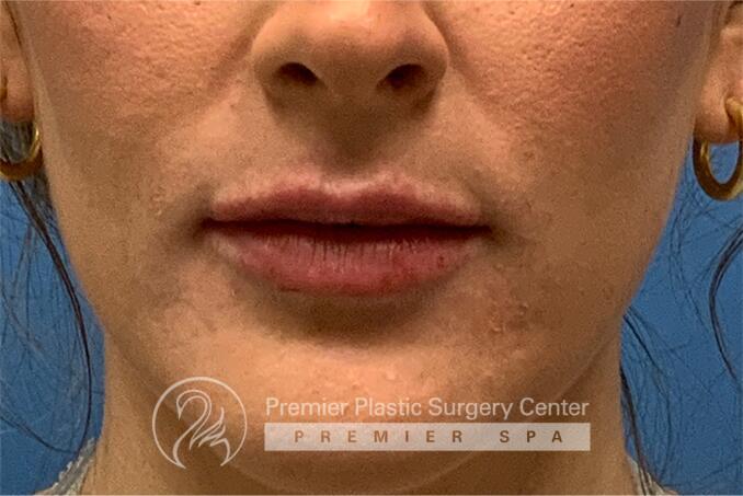 Lip Augmentation Before & After Image