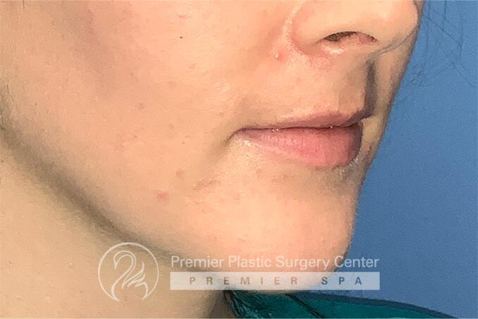 Lip Augmentation Before & After Image