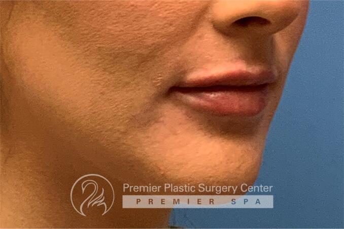 Lip Augmentation Before & After Image