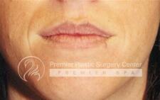 Lip Augmentation Before & After Image