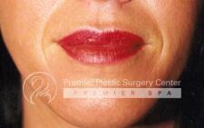 Lip Augmentation Before & After Image