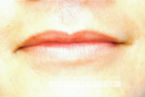 Lip Augmentation Before & After Image