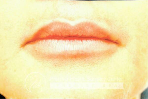 Lip Augmentation Before & After Image