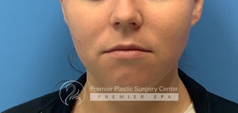 Lip Augmentation Before & After Image